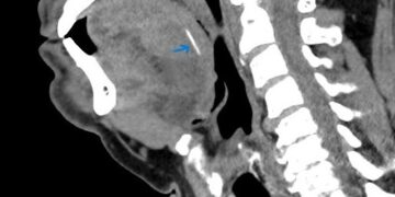 צפת: עצם דג באורך שני ס”מ נשלפה מלשונו של מטופל