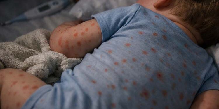 תינוק בן 11 חודשים נפטר מסיבוכי מחלת חצבת