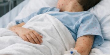 משרד הבריאות: ילד בן תשע נפטר מחצבת